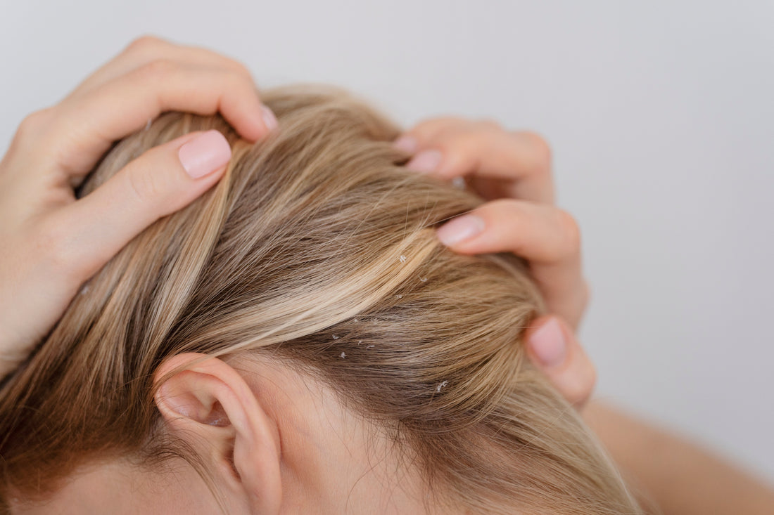 Psoriasis du cuir chevelu et chute de cheveux : comprendre, agir et retrouver une chevelure saine - Theralica